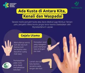Kasus Kusta di Karawang Meningkat, Dinkes Gencarkan Deteksi Dini dan Layanan Gratis