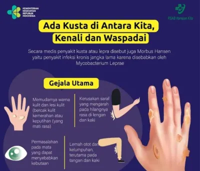 Kasus Kusta di Karawang Meningkat, Dinkes Gencarkan Deteksi Dini dan Layanan Gratis