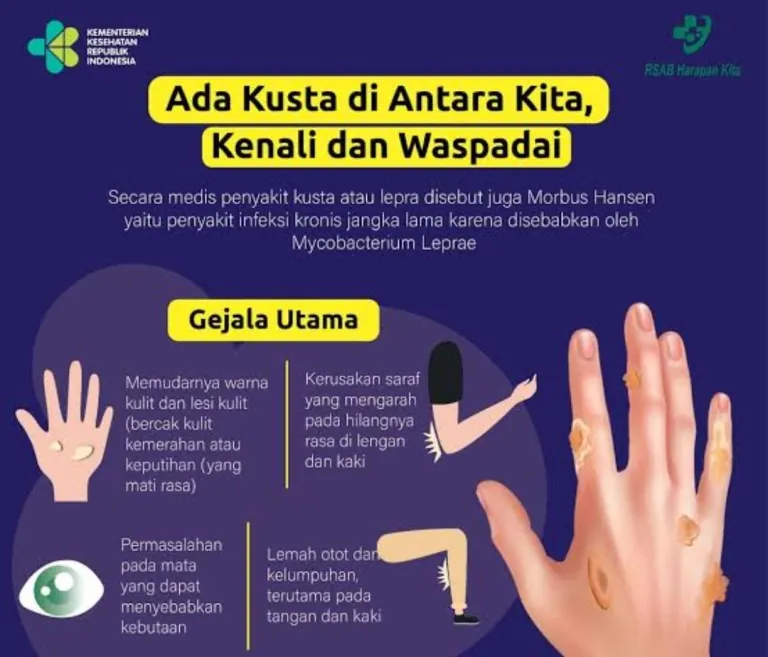 Kasus Kusta di Karawang Meningkat, Dinkes Gencarkan Deteksi Dini dan Layanan Gratis